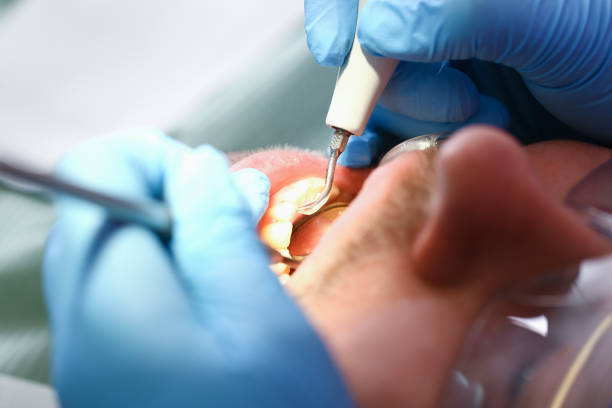Best Emergency Wisdom Tooth Extraction in Grant, AL